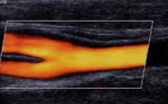 Duplex- Carotiden