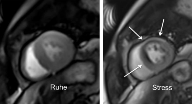 Herz/Kardio- MRT unter Stressbedingungen